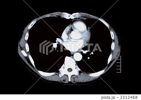 胸部 Ct 検査 肺の写真素材