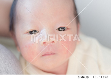 新生児ニキビの写真素材
