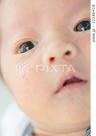 新生児黄疸の写真素材 - PIXTA