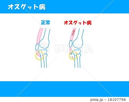 オスグット病のイラスト素材