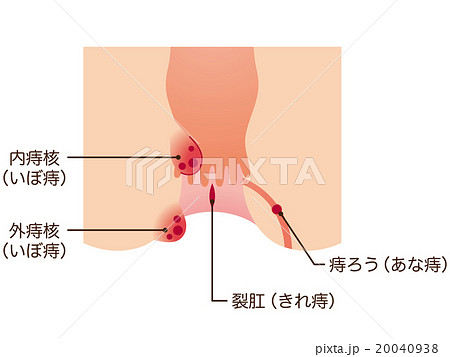 いぼ痔のイラスト素材 - PIXTA