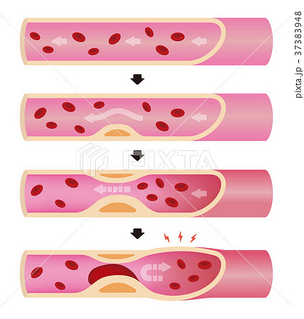 動脈硬化のイラスト素材