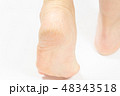 中高年女性のかかと ひび割れ 角化症の写真素材