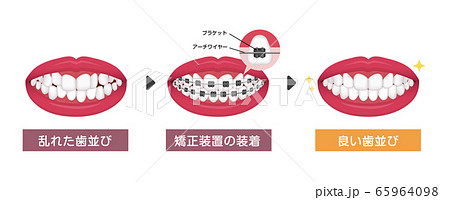 歯列のイラスト素材