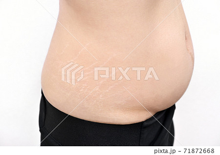 肉割れ線の写真素材