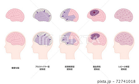 アルツハイマー型認知症のイラスト素材