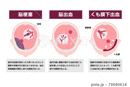 脳出血のイラスト素材