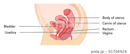 A Cystocele is Also Known As a Bladder Prolapse, a Fallen Bladder